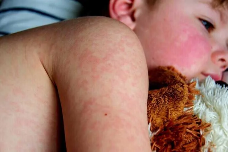 Ã‰pidÃ©mie de rougeole en Occitanie : la prÃ©fecture de lâ€™AriÃ¨ge tire la sonnette dâ€™alarme